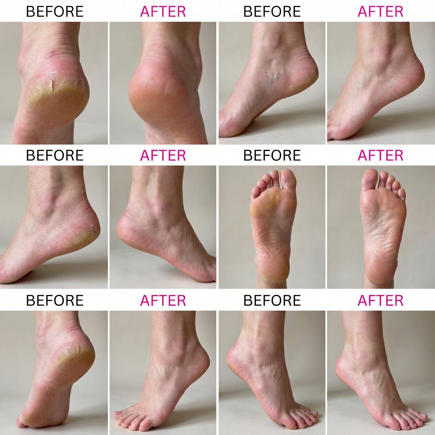 Callus Remover™